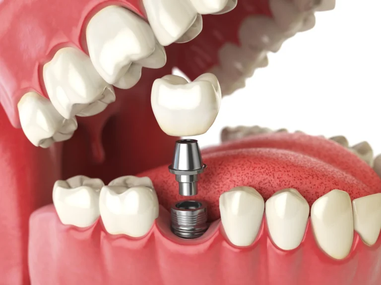 How Modern Dental Implants Restore Your Ability to Enjoy Crunchy and Chewy Foods Again